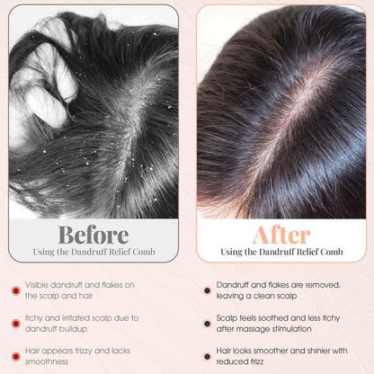 Scalp Sweep Dandruff Removal Massage Comb for Greasy Scalp Promotes Blood Circulations Removes Oil Dandruff Enhances Hair Shine